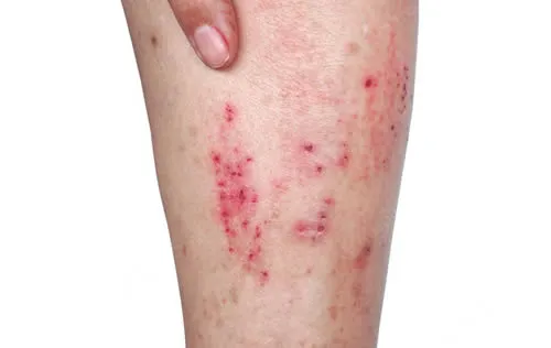 age-spots atopic dermatitis on legs