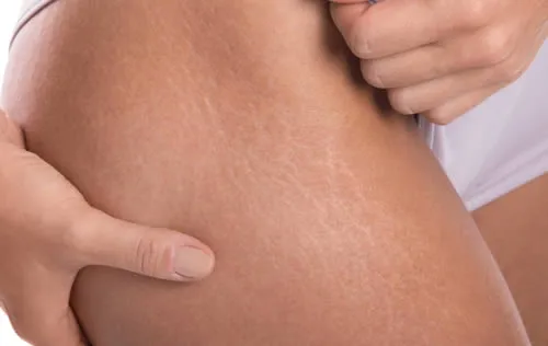 age-spots female-hips-with-stretch-marks