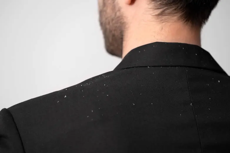 age-spots close-up-man-with-dandruff-problems